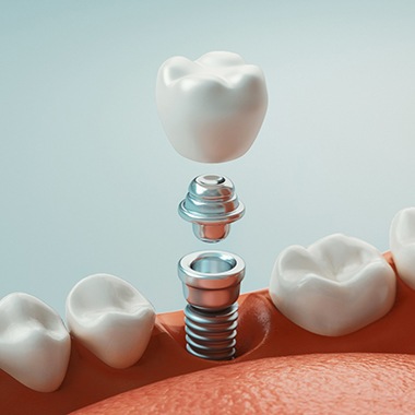 diagram of the parts of a dental implant with surrounding teeth 