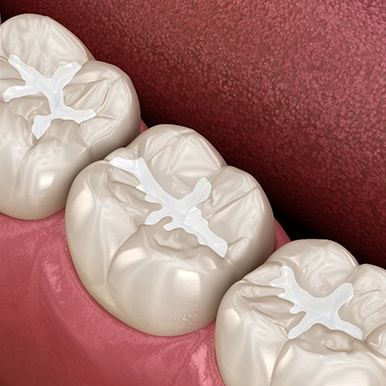 Rendering of tooth-colored fillings