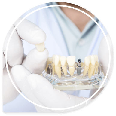 Dentist holding dental crown in one hand and model of mouth with dental implant in the other