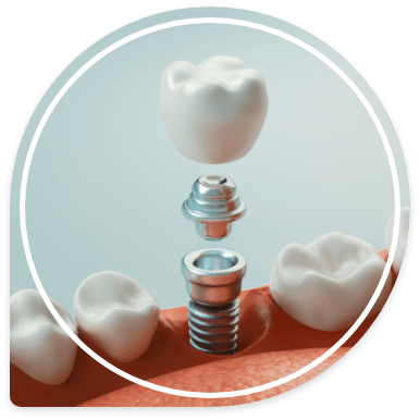 Animated dental implant with abutment and crown being placed in the lower jaw