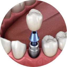 Animated dental crown being placed over a dental implant