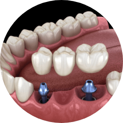 Animated dental bridge being placed over three dental implants