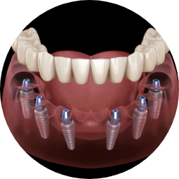 Animated full denture being placed over six dental implants