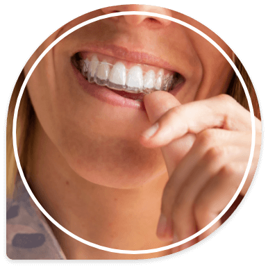 Close up of person placing Invisalign aligner over their teeth