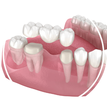 Animated dental bridge being placed to replace missing tooth