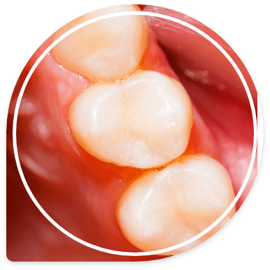 Close up of row of teeth with tooth colored fillings