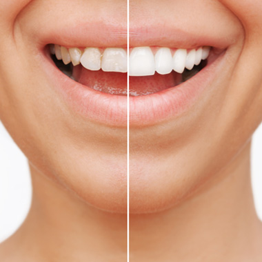 The benefits of veneers include durability and stain resistance.