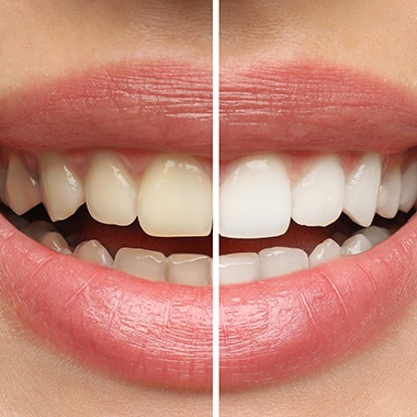 Closeup of teeth that are half whitened to show before/after treatment results